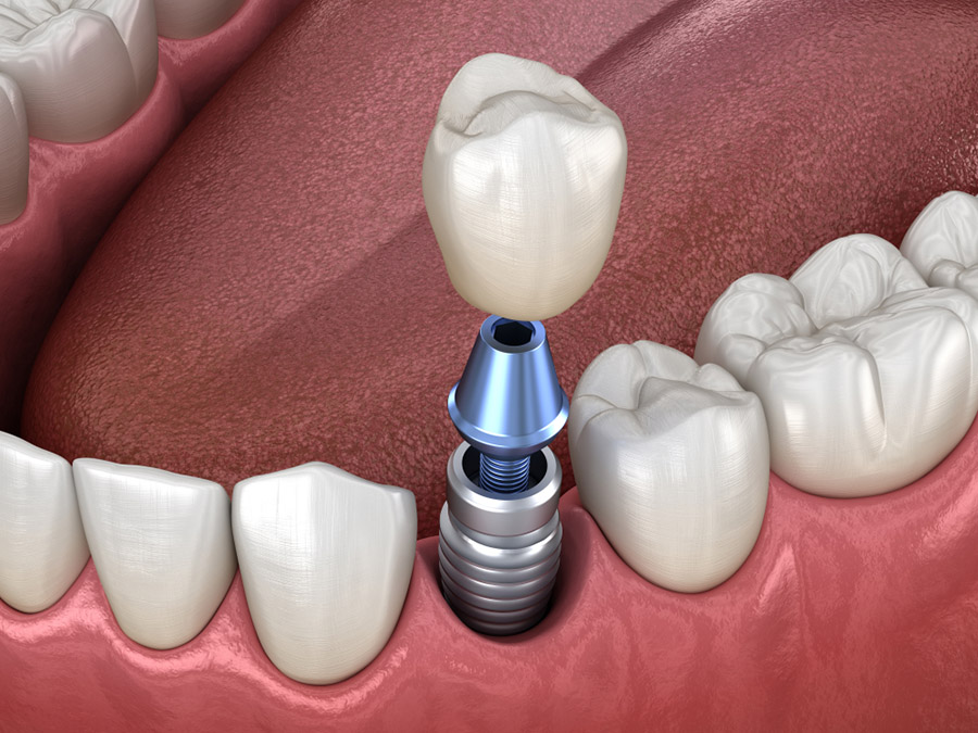 Clínica Dental Uradent Cirugía dental implante unitario