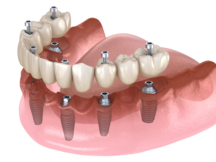 Clínica Dental Uradent Cirugía dental prótesis sobre implantes