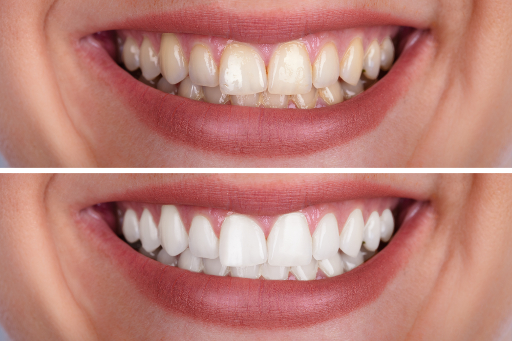 Clínica Dental Uradent BLANQUEMIENTO DENTAL antes y después