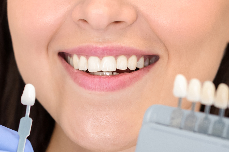 Clínica Dental Uradent tratamiento de blanqueamiento dental mujer
