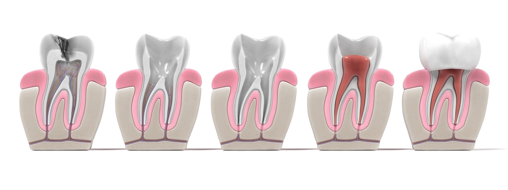 Pasos Endodoncia Clínica Dental Uradent