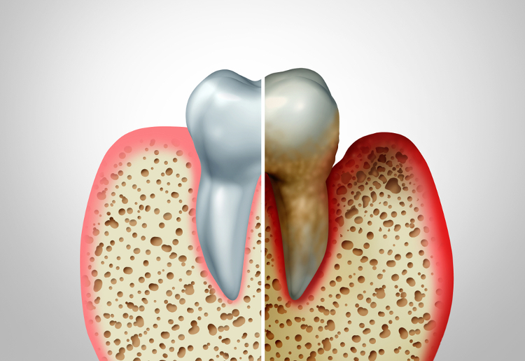 Periodoncia Periodontitis Tratamiento Clínica Dental Uradent