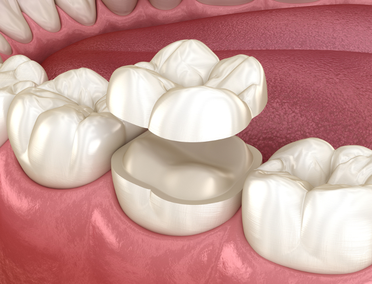 Clínica Dental Uradent tratamientos Uradent odontología conservadora incrustación