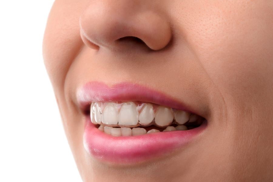 Clínica Dental Uradent tratamiento ortodoncia invisible