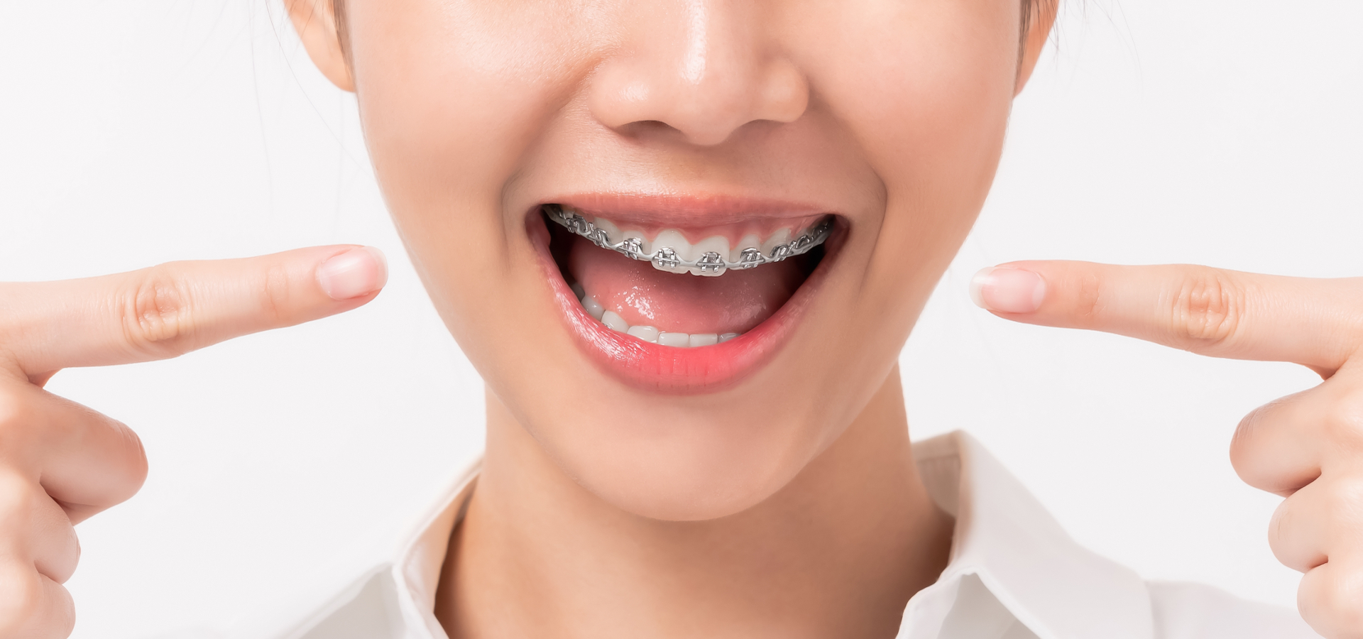 Clínica Dental Uradent tratamiento de ortodoncia metálica y estética